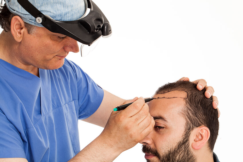 What is a hair transplant?
