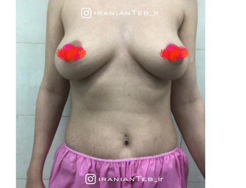 نمونه کار قبل و بعد از عمل پروتز سینه