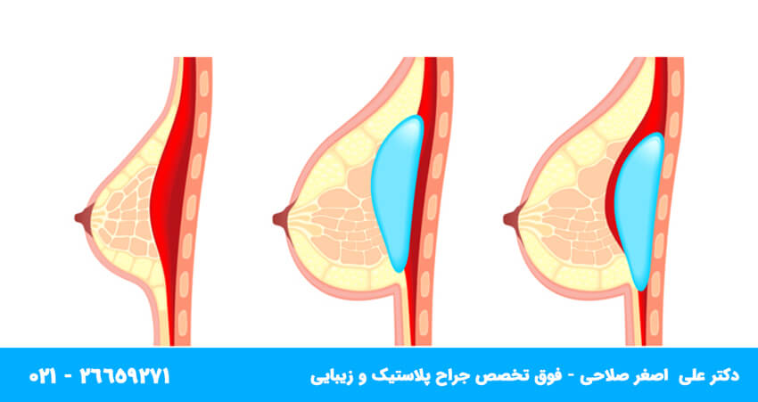 تفاوت عمل کوچک کردن سینه و لیفت سینه (ماموپلاستی و ماستوپکسی