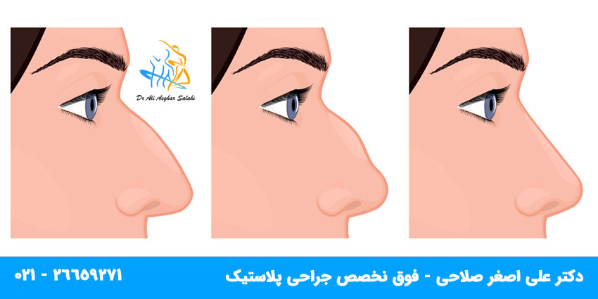 قبل و بعد از عمل جراحی بینی