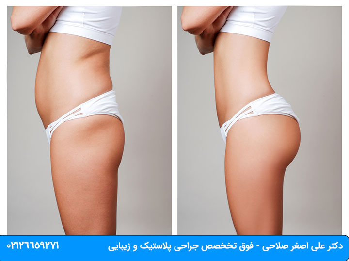فیلم عمل جراحی شکم برای لاغری+فیلم و عکس پیکر تراشی بدون سانسور