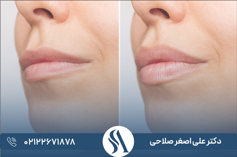 بهترین انواع ژل لب [ 12 مدل‌ از پرطرفدارترین مدل ژل لب ] | دکتر علی ...